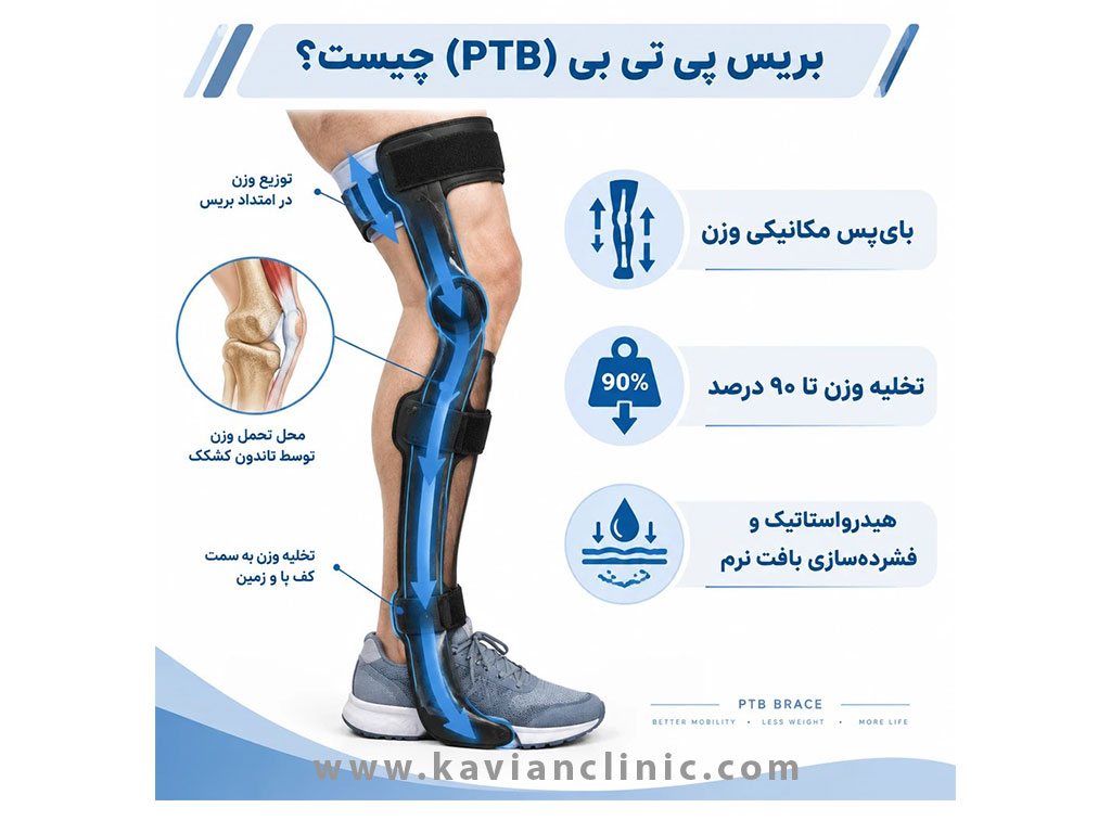 بریس پی تی بی چیست