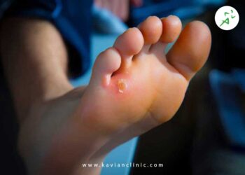 درمان میخچه پا