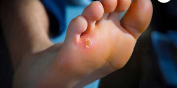 درمان میخچه پا