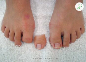 قیمت پروتز انگشت پا