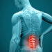 بررسی علت دیسک کمر و روش های درمان آن