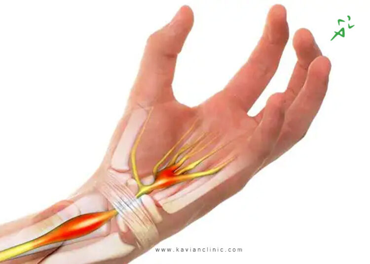 علت سندرم تونل کارپال چیست و روش های درمان آن