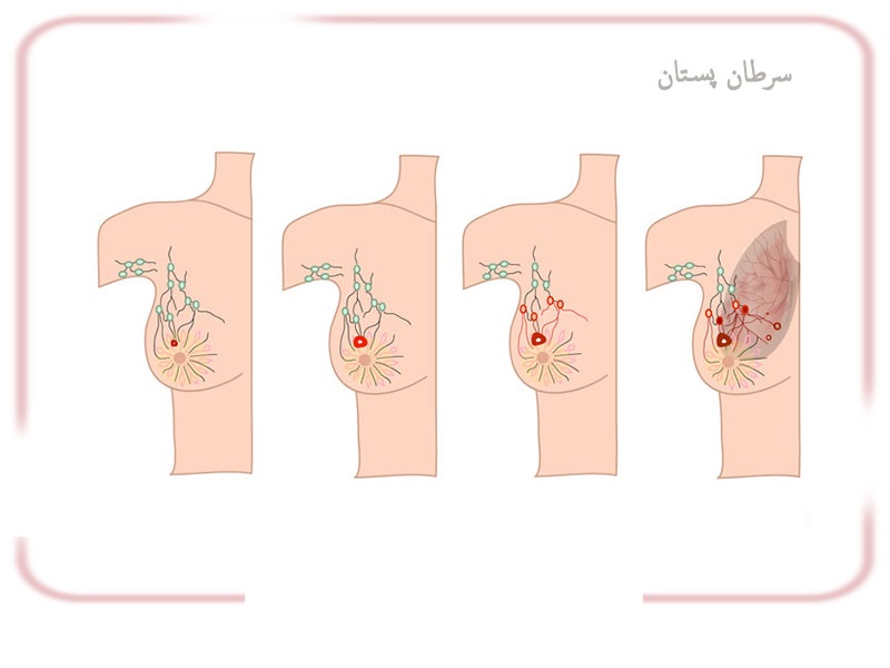 چه زمانی از جراحی برداشتن سینه یا پستان ماستکتومی استفاده می شود؟