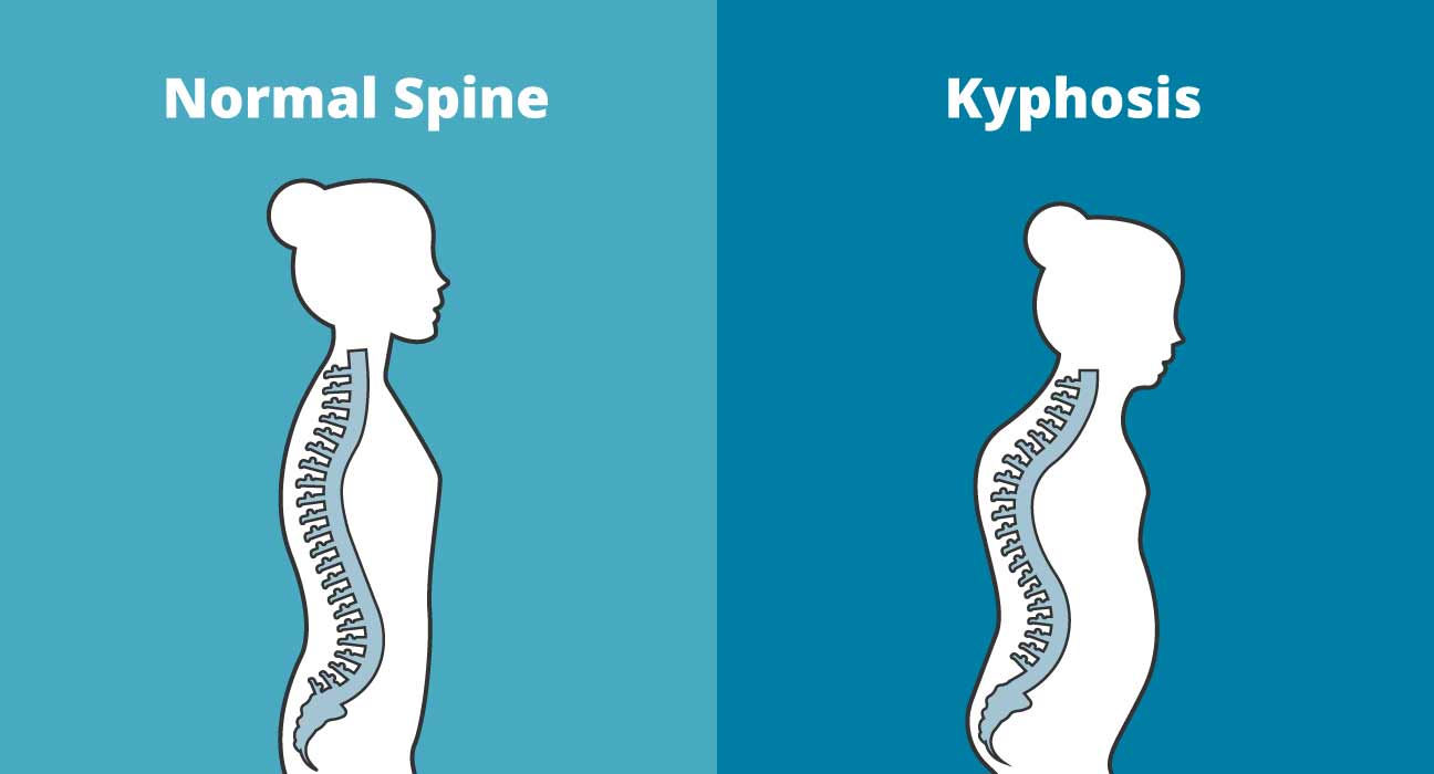 کیفوز چیست و علائم کیفوز