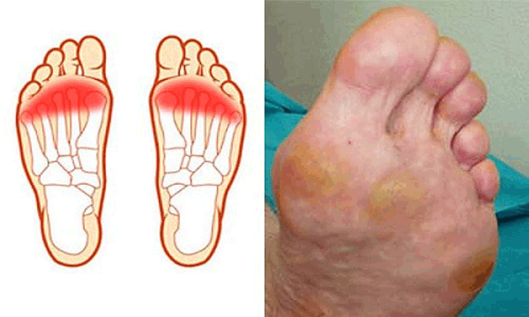 راه های تشخیص بیماری متاتارسالژیا