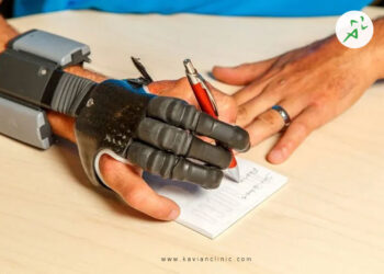 پروتز دست: ویژگیهای دست مصنوعی چیست