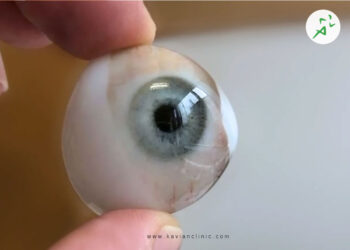 قیمت پروتز چشم در تهران چقدر است