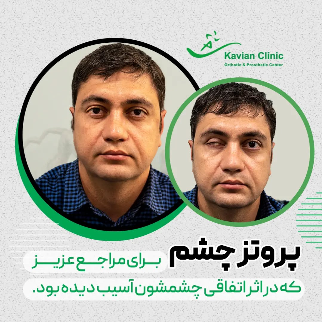 تجربه زندگی با چشم مصنوعی